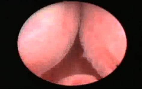   plazma kinetik teknoloji ile prostat tedavisi görsel 1