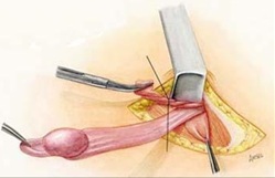  inmemiş testis ameliyatı görüntüsü