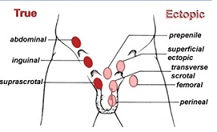  inmemiş testis lokalizasyonları