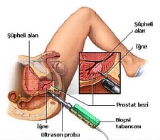  Transrektal ultrasonografi eşliğinde ağrısız prostat biyopsisi