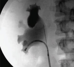RIRS  böbrek taşlarının tedavisinde retrograd intrarenal taş cerrahisi