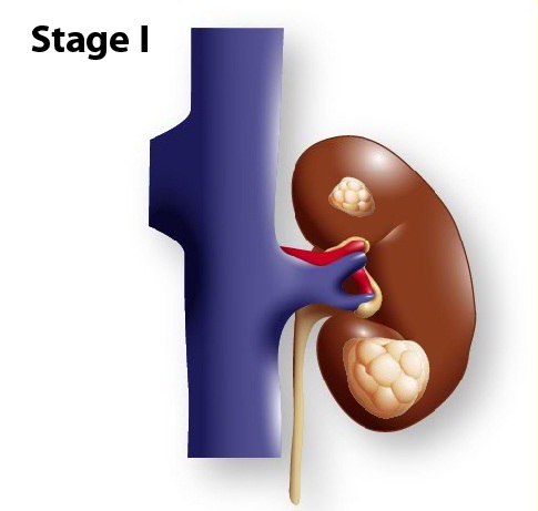  Evre 1 Böbrek Kanseri