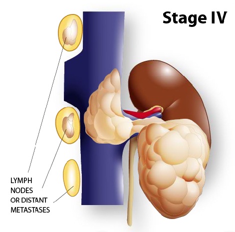  Evre 4 Böbrek Kanseri